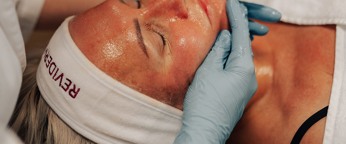 Couperose treatment: a treatment for couperose-prone skin and early-stage rosacea Couperose treatment: a treatment for couperose-prone skin and early-stage rosacea