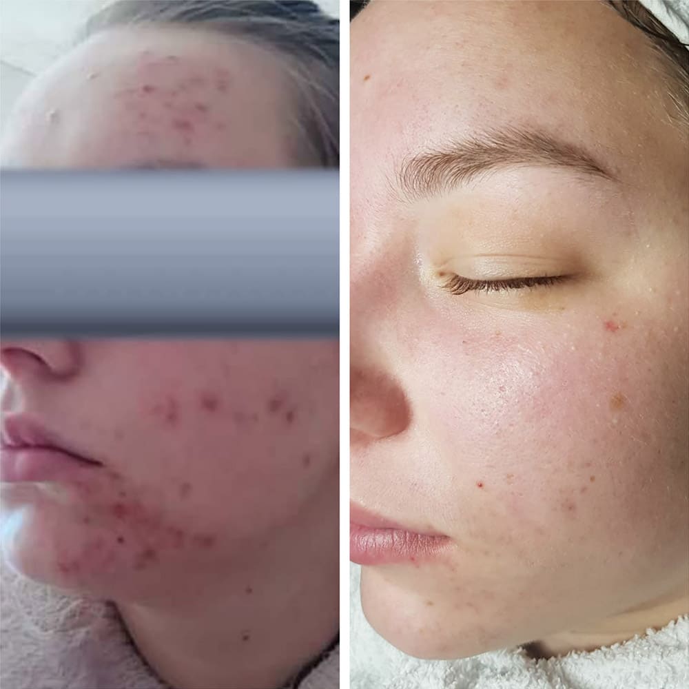 Results Skin Refiner Fluid REVIDERM.uk Results Skin Refiner Fluid REVIDERM.uk